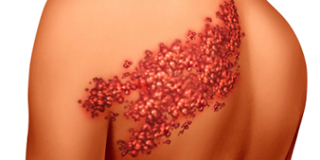 الحزام الناري وعلاجه