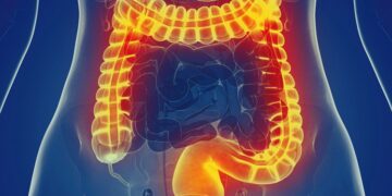 اعراض سرطان القولون