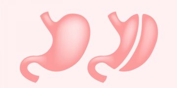 تكميم المعدة