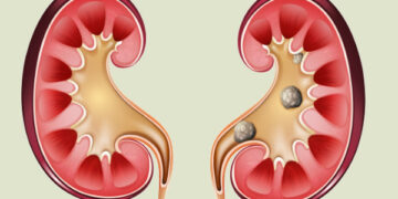 حصوة الحالب