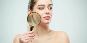 تينيا الجلد