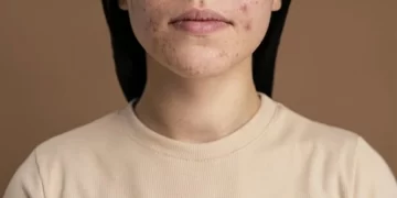 حبوب تحت الجلد