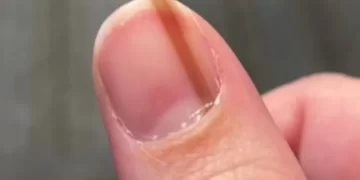 سرطان الجلد