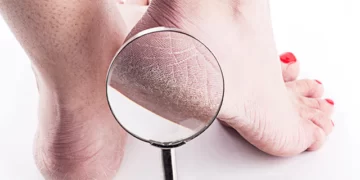 علاج تشقق القدمين