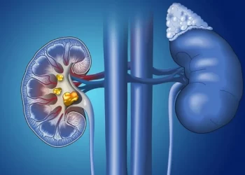 أعراض حصوات الكلى