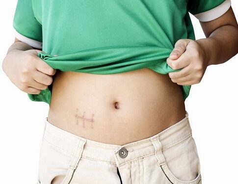 التهاب الزائدة الدودية