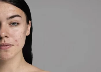 ظهور بقع حمراء على البشرة