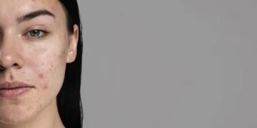 ظهور بقع حمراء على البشرة