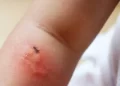 لدغات البعوض