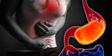 علاج ارتجاع المريء