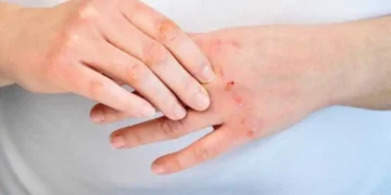 علامات السكري على الجلد