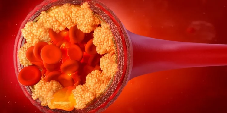 أعراض ارتفاع الكوليسترول