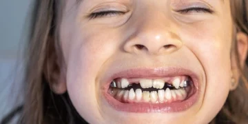 أسباب الأسنان الطباشيرية عند الأطفال