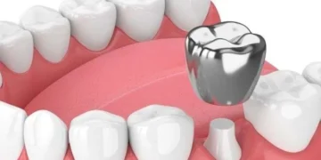 هل طربوش الأسنان ضروري